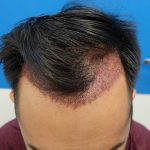 hair transplant in Turkey