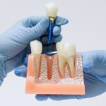 OutstandingTeeth Implants Abroad