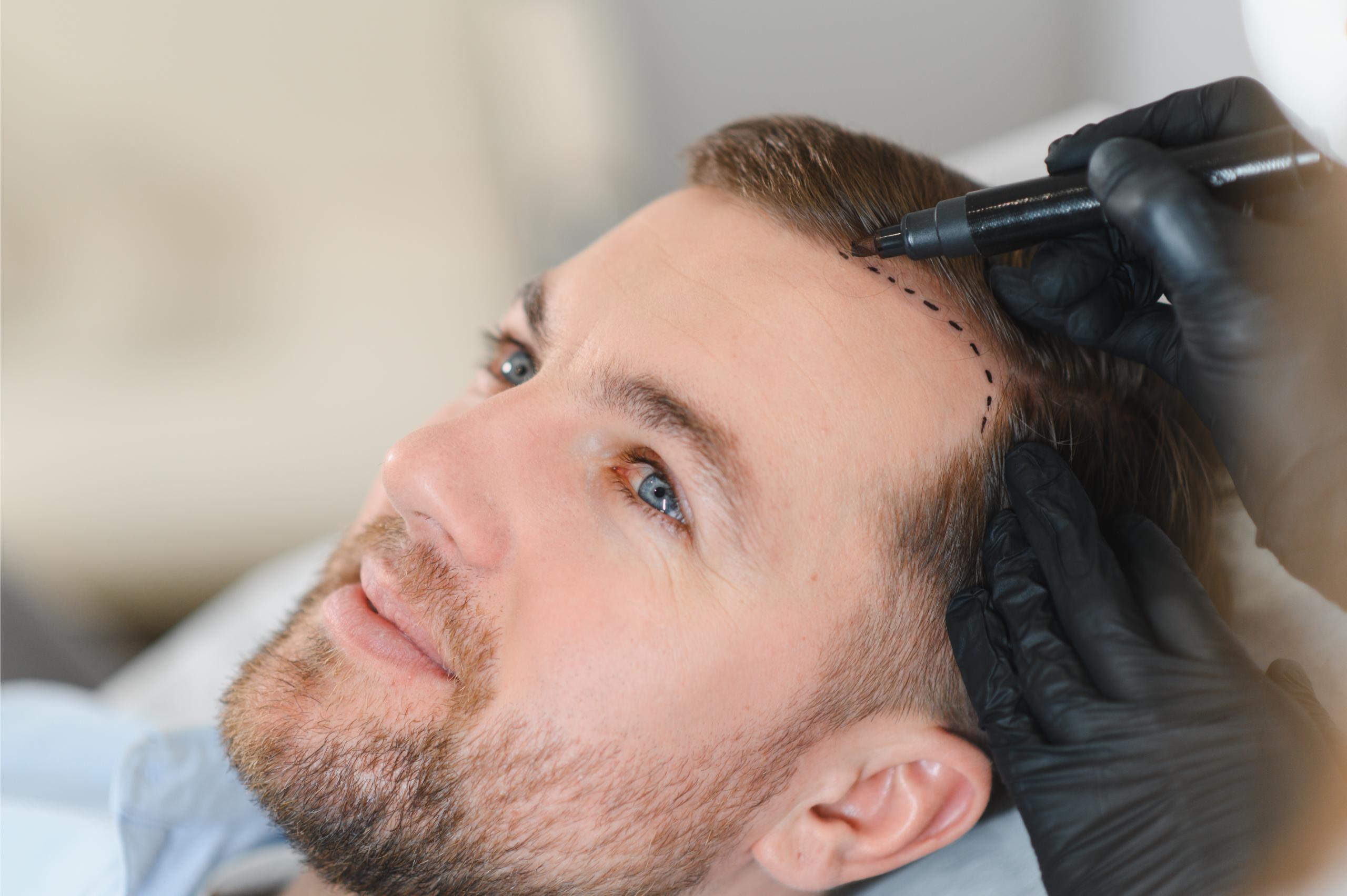 How Turkey Became The Global Capital Of Hair Transplants In 2022