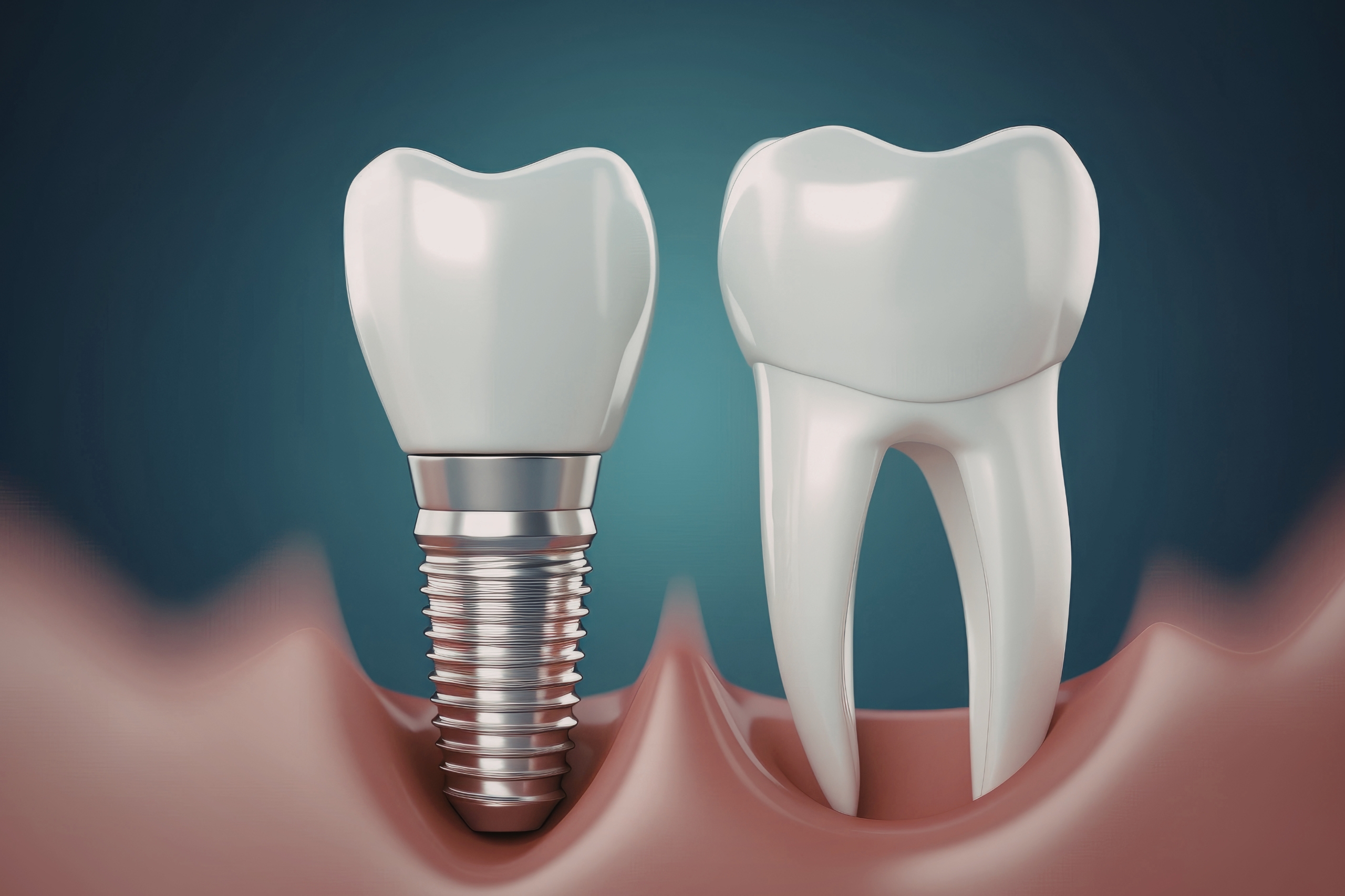 Teeth Implants - Exactly Why People Choose In order To Go Abroad With Regard To Dental Implants Throughout 2022
