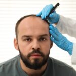 Why Hair Transplant Surgery In Turkey Is So Cheap