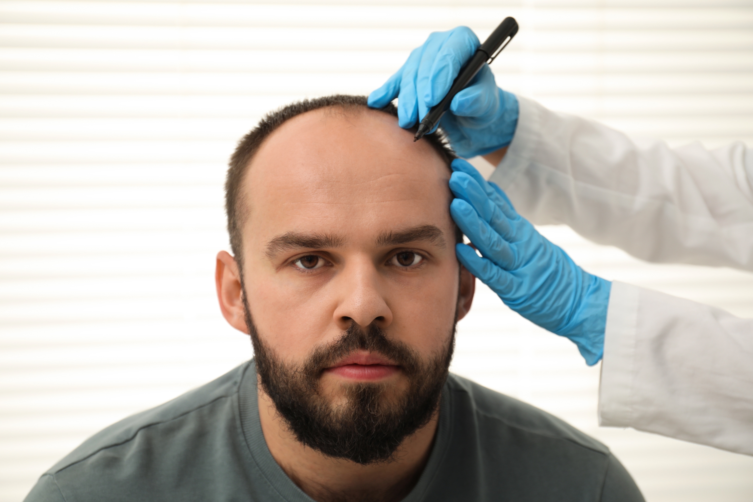 Why Hair Transplant Surgery In Turkey Is So Cheap